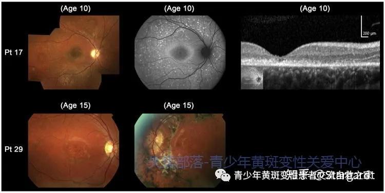 特徵的2個基因確診病例的彩色眼底照片,光譜域光學相干斷層掃描圖像