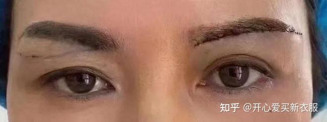 深扒提眉和割眼袋的后遗症的谜割眼袋加提眉多久能恢复自然