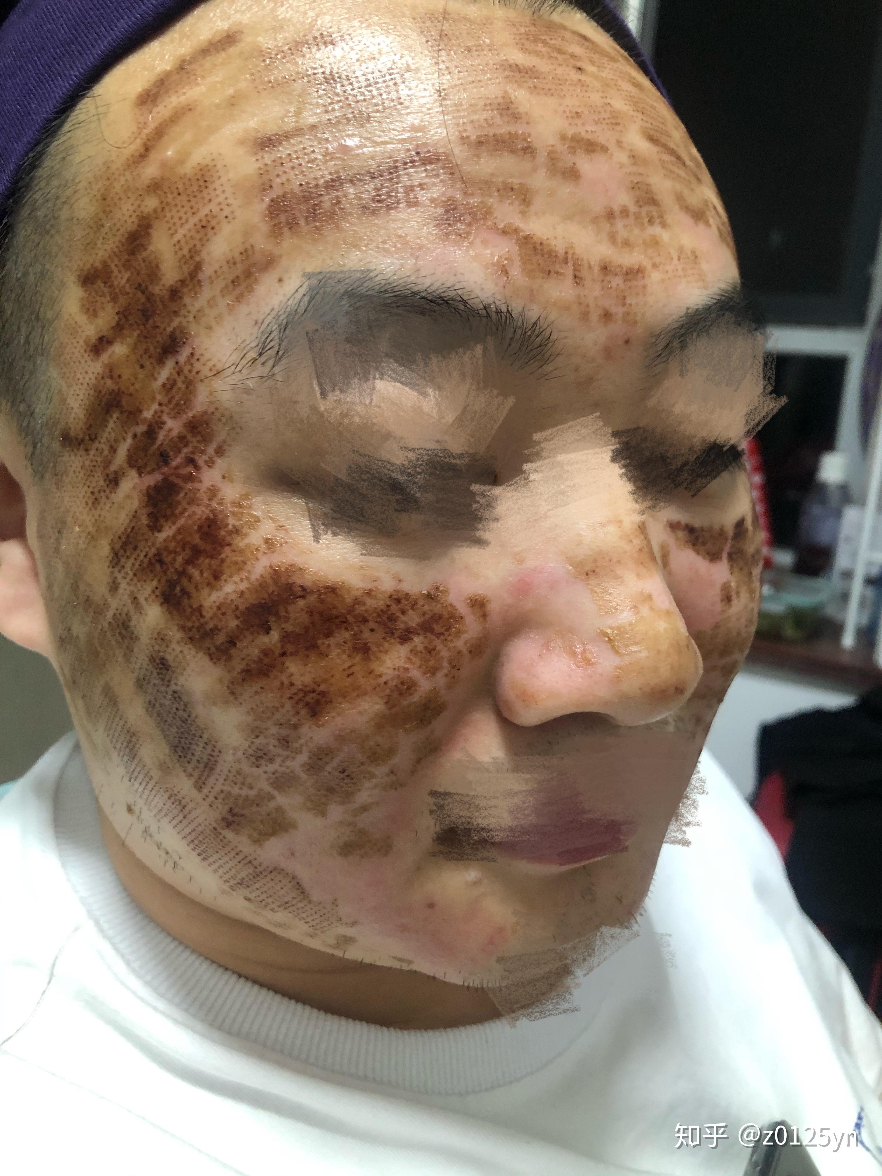 记录男朋友点阵激光的历程