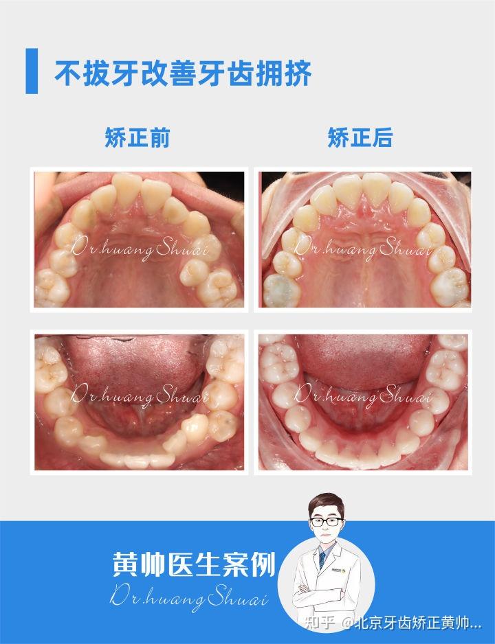 凸嘴可以矫正改善