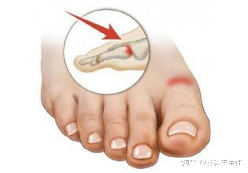 大脚趾长歪了，拇囊炎还是关节炎，耽误了就麻烦了 - 知乎