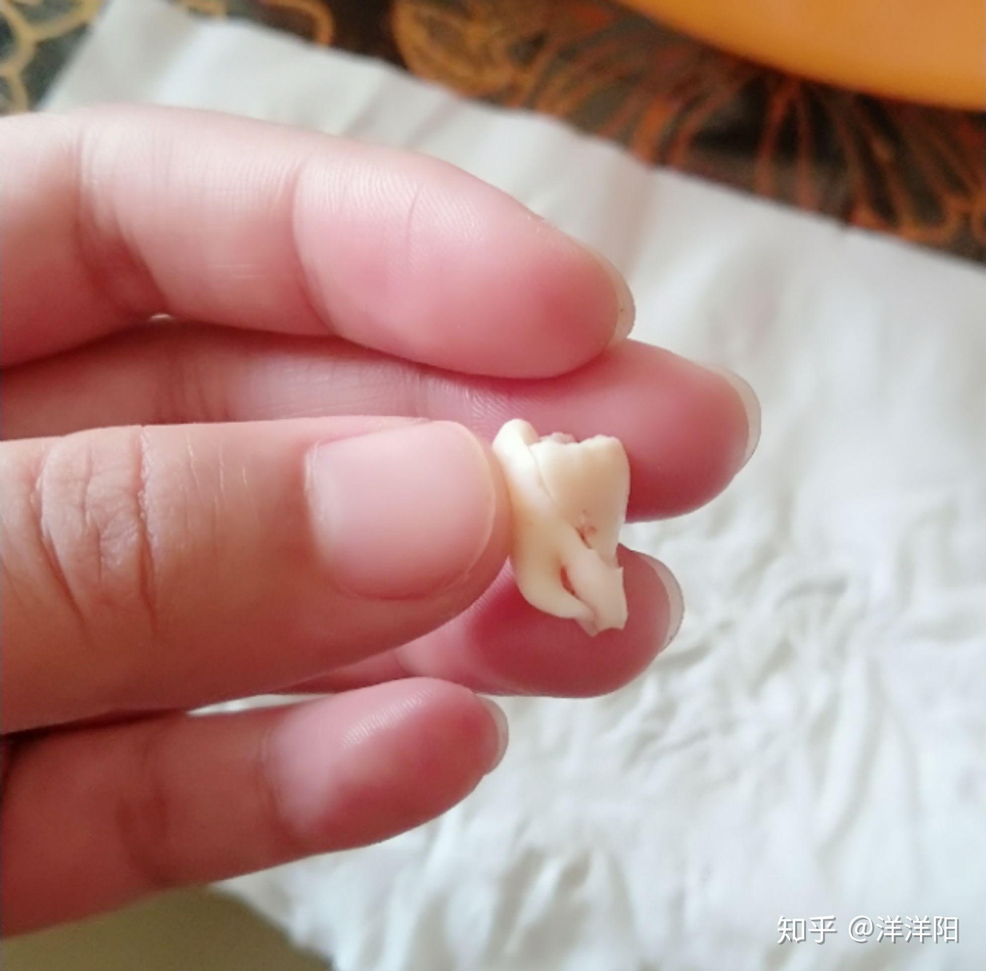 论拔完智齿的痛苦