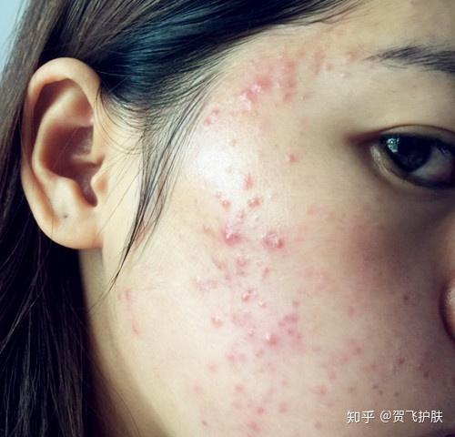 痘痘肌该如何改善呢