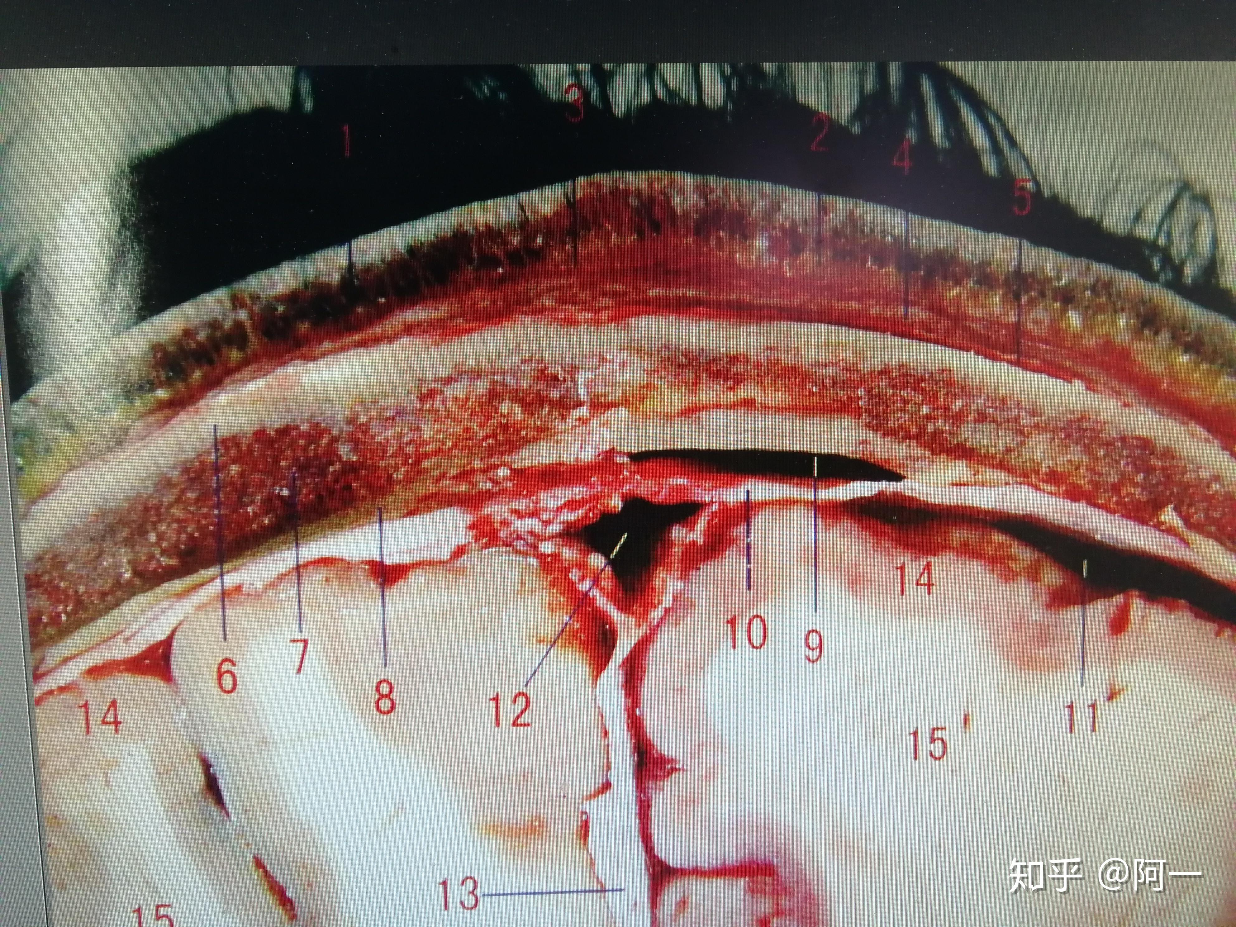 帽状腱膜和骨膜图片