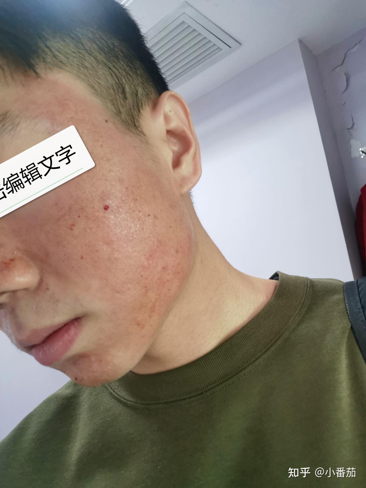 第一次点阵激光记录