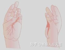 25 周围神经损伤 - 知乎