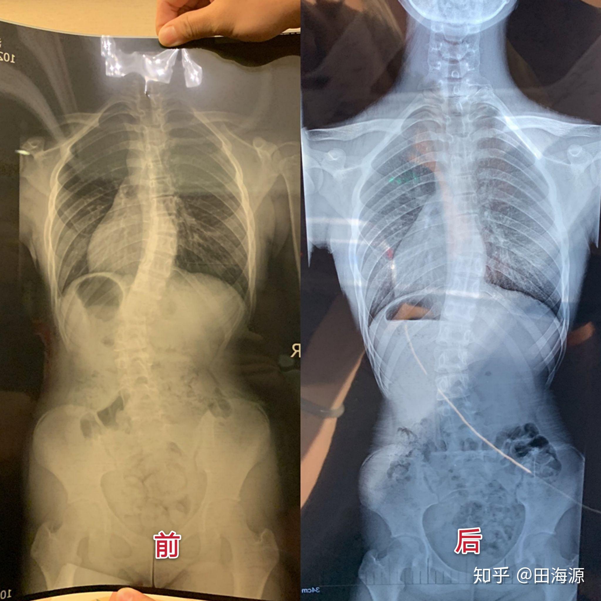 15岁脊柱侧弯32度(线上3个月)