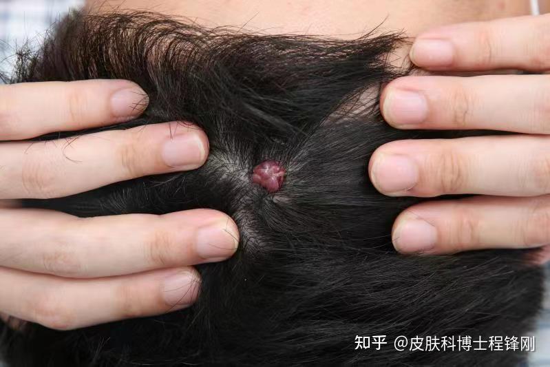 28岁男子洗头时不小心把头皮抓破了,一个月后长出"小红樱桃"