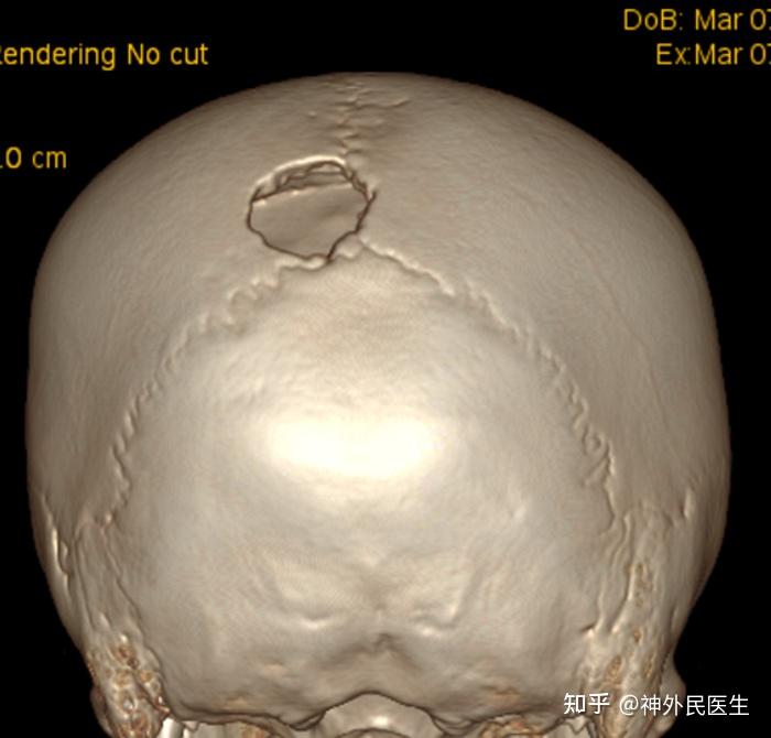 儿童颅骨骨瘤图片图片