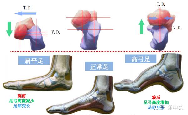 扁平足的康复治疗 知乎