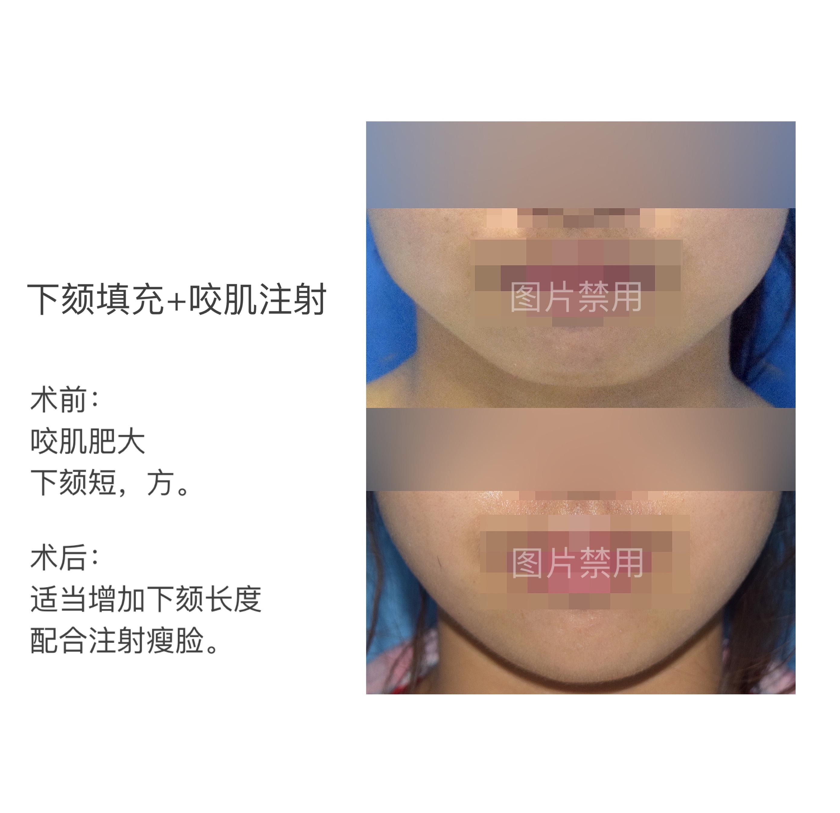 颊部网格化分区与脂肪移植 - 微医（挂号网）