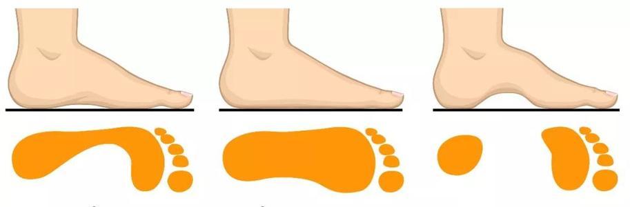 长了一双"鸭脚掌"是什么体验?最多行走300米,平足的血泪史!