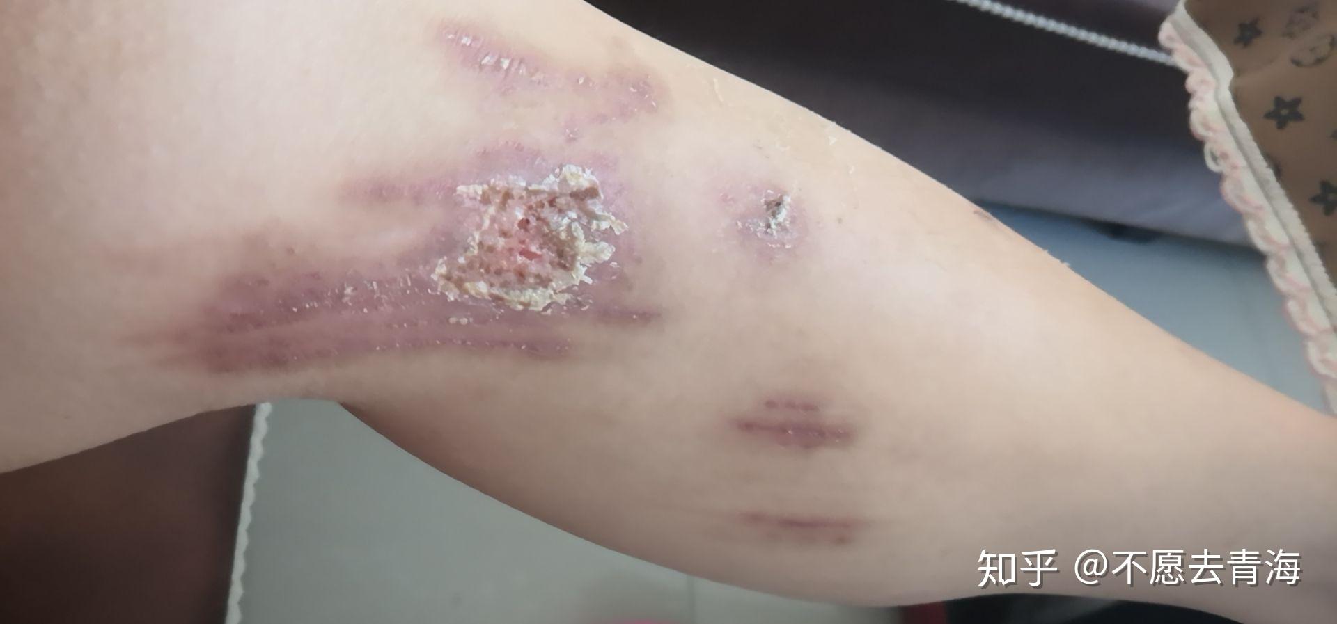 月以后的伤口)医生说可能要两三年才会淡下去但这次的经历却成了烙印