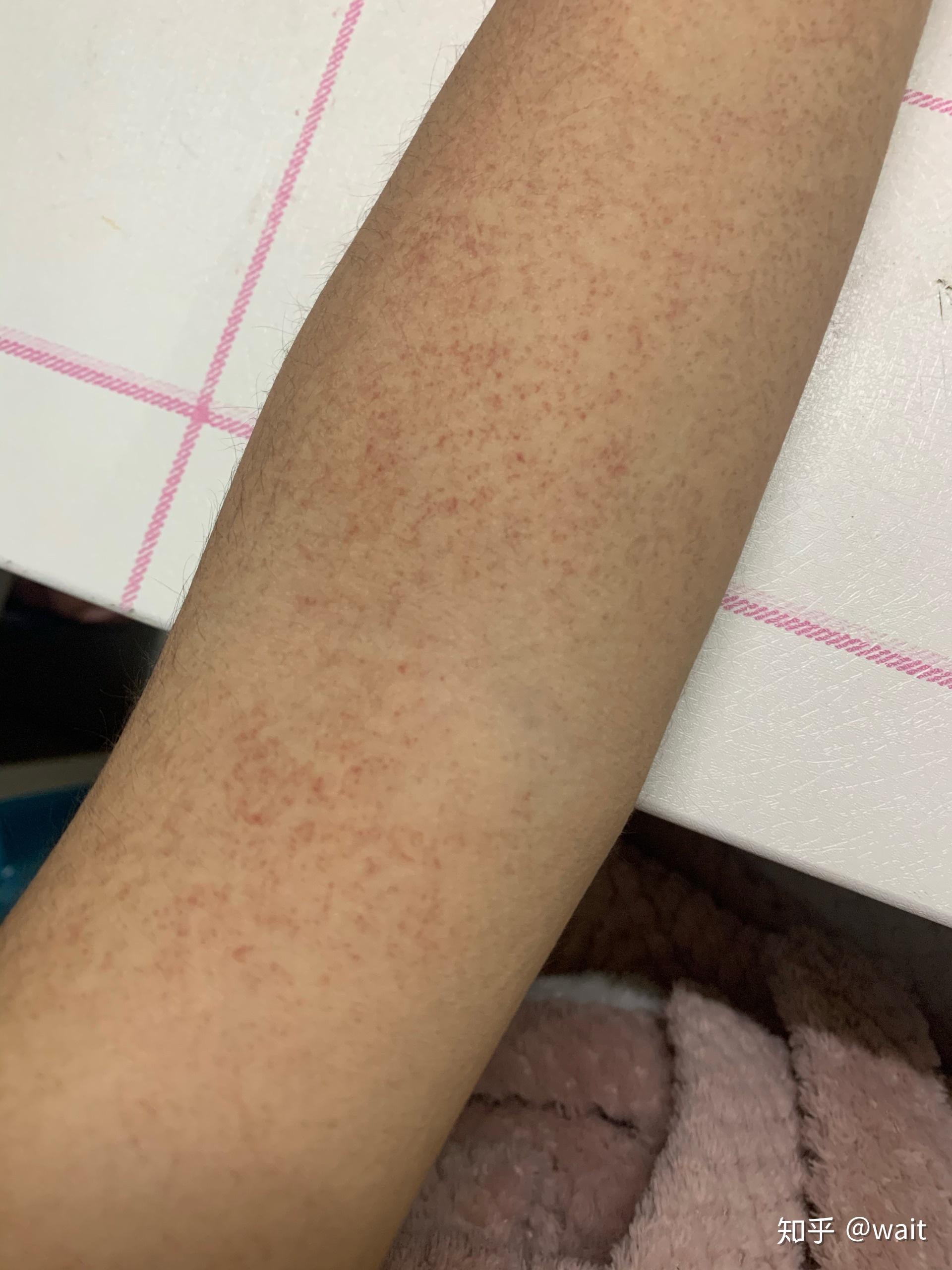 手臂上身上有红点点
