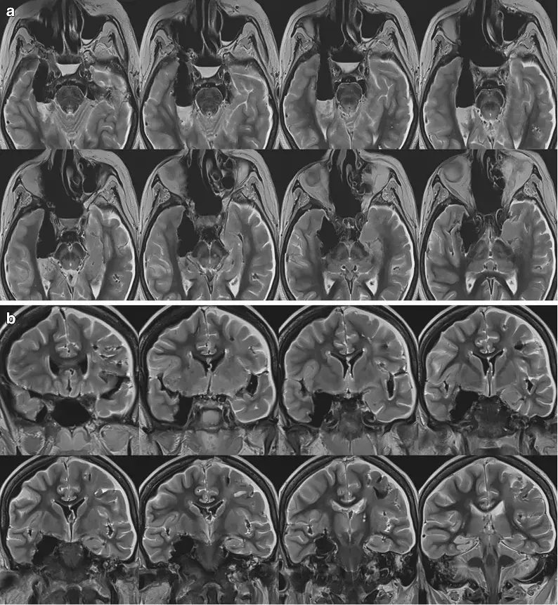 杏仁体MRI图片